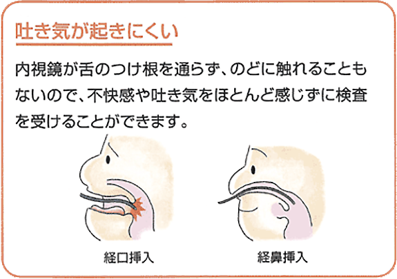 吐き気が起きにくい